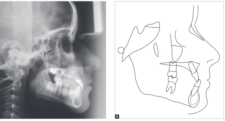 Figure 4 - Initial lateral cephalogram (A) and cephalometric tracing (B).