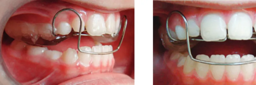 Figure 5 - Protraction archwire.