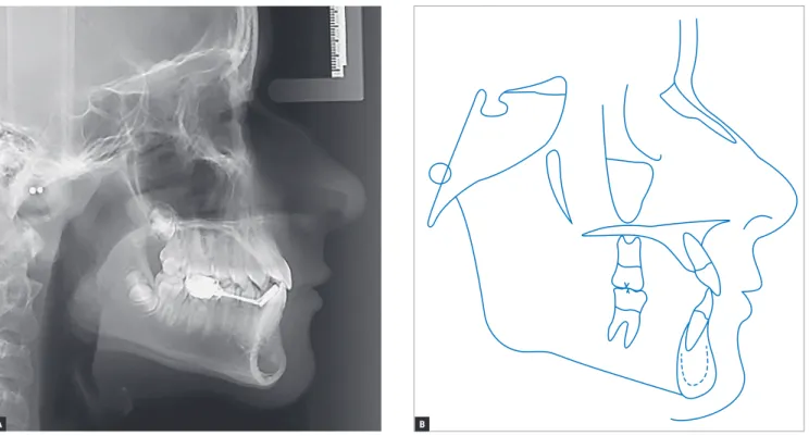 Figure 9 - Intermediate lateral cephalogram (A) and cephalometric tracing (B).