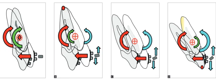 Figure 3 - Types of tooth movement: A) Uncontrolled tipping; B) Controlled tipping; C) Bodily movement; D) Root movement