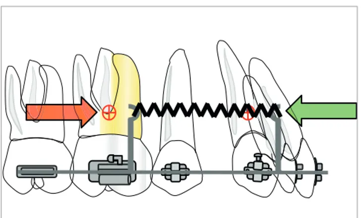 Figure 7 - Force system generated by a closed coil spring applying forces  at the level of the center of resistance by means of extension hooks (power  arms)