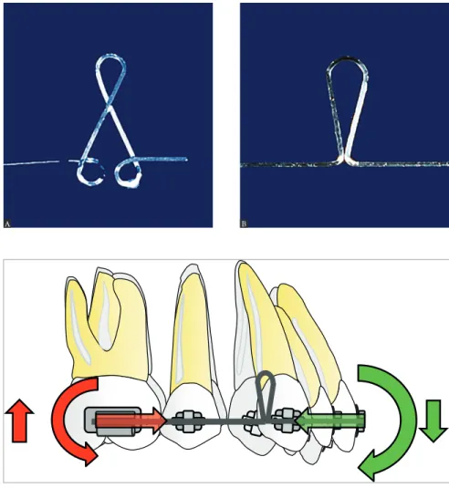 Figure 8 - A) Closing loop with bends in the  winding-direction. This configuration presents  more resistance to permanent deformation  dur-ing activation; B) Closdur-ing loop with bends in  unwinding-direction.