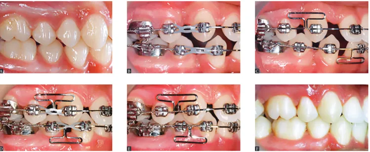 Figure 13 - Clinical case with all four first premolar extractions. A) Initial; B) Partial canine retraction; C) Beginning of space closure using a T-loop design; D) Prog- D) Prog-ress of space closure; E) Management of canine relationship; F) End of the c
