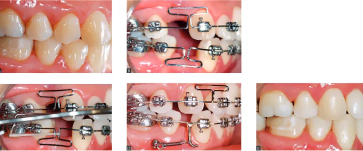 Figure 14 - Management of space closure in a surgical case. A) Initial phase; B) Space closure phase; 