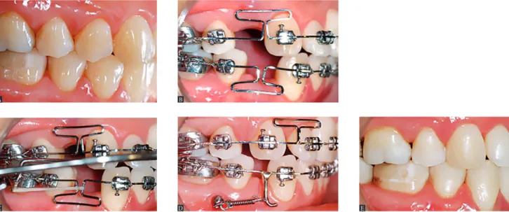Figure 14 - Management of space closure in a surgical case. A) Initial phase; B) Space closure phase; 