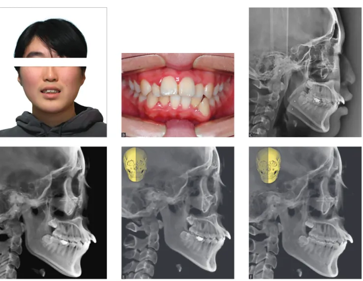 Figure 1 - Generation of cephalograms from cone-beam volume image. A 20-year-old lady came to us complaining of upper anterior protrusion (A and B)