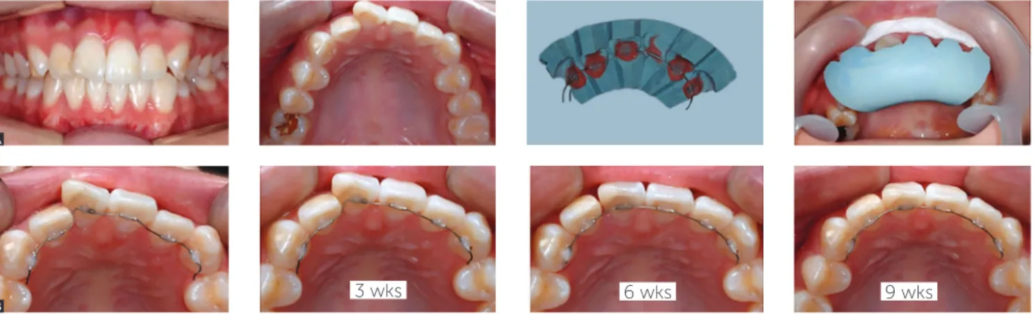 Figure 8 - Lingual application of mini-tube appliance (MTA). The mini-tubes can be placed also in the lingual surface