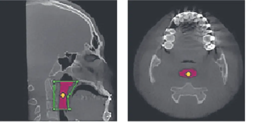 Figure 2 - Area determined by the main marker in three multiplanar sections (sagittal, axial and coronal).