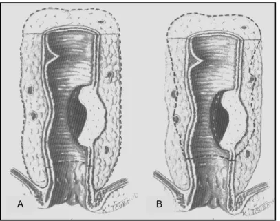 Figura 3  – Aspecto final do mesorreto após a dissecção pélvica. 