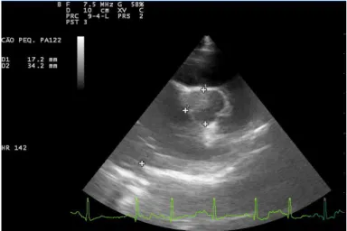 Fig.  3 – Ecocardiografia paraesternal direita do átrio esquerdo,  que revela uma grande dilatação e uma razão AE/AO&gt; 2