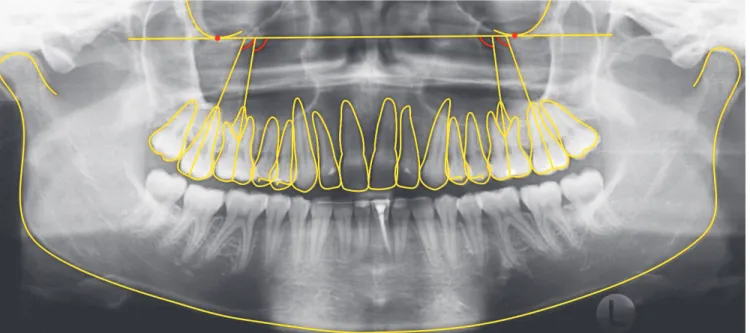 Figure 4 - Angular measurements between long axes of teeth and upper reference line.