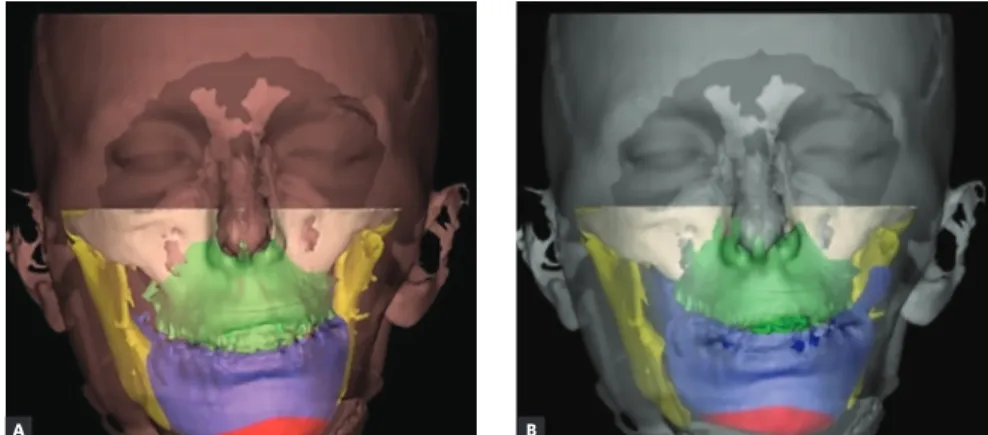 Figure 6 - 3D planned intermediate (A) and final  (B) situation with the virtual splint set between  the dental arches