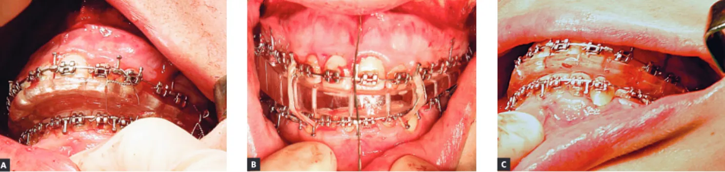 Figure 7 - Intraoperative situation of the conventional initial splint (A), intermediate CAD/CAM splint (B) and final CAD/CAM splint (C) fitting the dental arches.