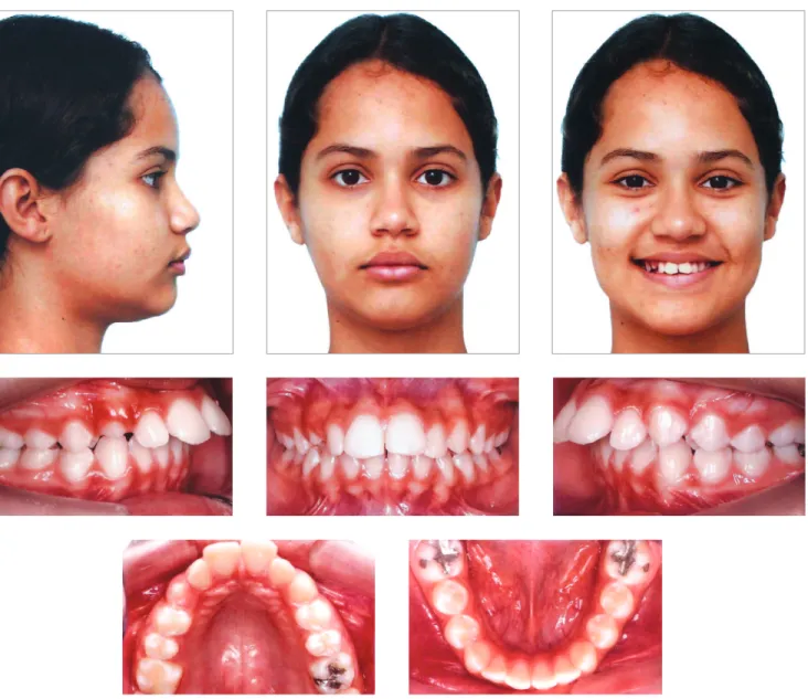 Figure 1 - Initial facial and intraoral photographs.