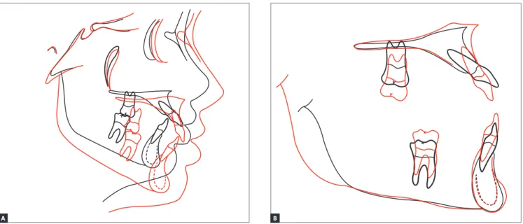 Figure 10 - Total (A) and partial (B) superimpositions. Initial (black) and final (red).