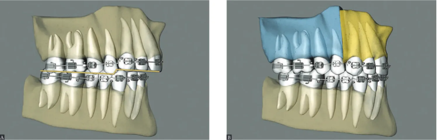 Figure 14 - Lateral view illustrative of three-segment maxillary surgery, with correction of the Curve of Spee, enlarged in the maxilla