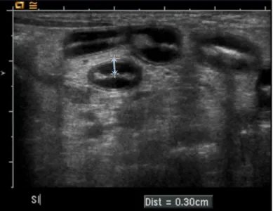 Figura  17  –  Ecografia  abdominal  transversal  do  Intestino delgado. Observa-se uma espessura da  parede  dentro  dos  valores  de  referência  (3  mm,  normal:  2-4  mm  para  o  íleo  e  2-5  mm  o  jejuno) 6  (imagem gentilmente cedida pelo UTCVM).