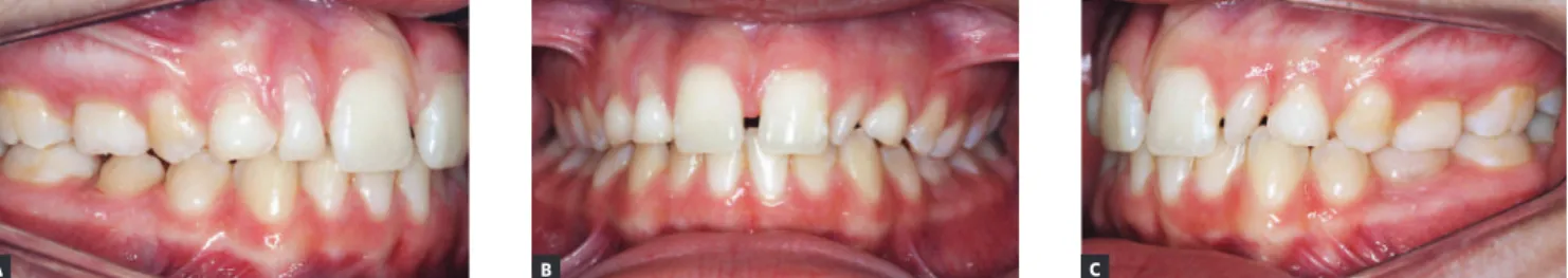 Figure 1 - White 13.7 years old patient, Class II (1/4) on the right side and Class I on the left side, with the maxillary middle line slightly shifted to the left