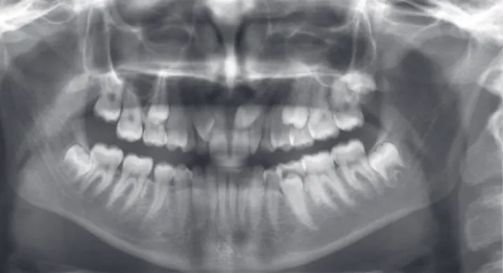 Figure 3 - In the panoramic radiograph, the bad positioning of the teeth #13  and # 23 stands out, with absence of the teeth # 12 and # 18