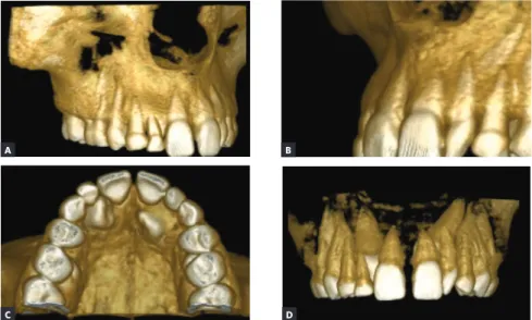 Figure 4 - Three-dimensional tomographic re- re-constructions, with greater precision regarding  the spatial location of unerupted canines in  the maxillary bone and their relationships with  neighboring permanent teeth and the retained  deciduous teeth in