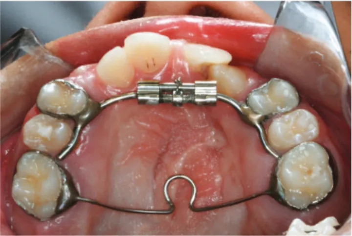 Figure 1  - Hyrax expander. Figure 2  - Inverted mini-Hyrax expander.