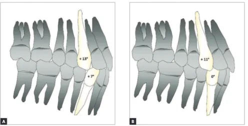 Figure 1 - Illustrative simulation of the influence  of canine angulation on incisor positioning