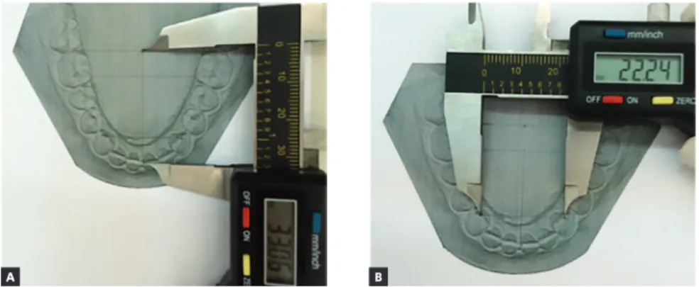 Figure 4 - Digital model evaluation, as follows: A) arch length, B) intercanine and C) intermolar widths.