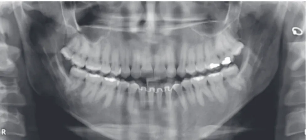 Figure 15 - Seven-years posttreatment dental models.