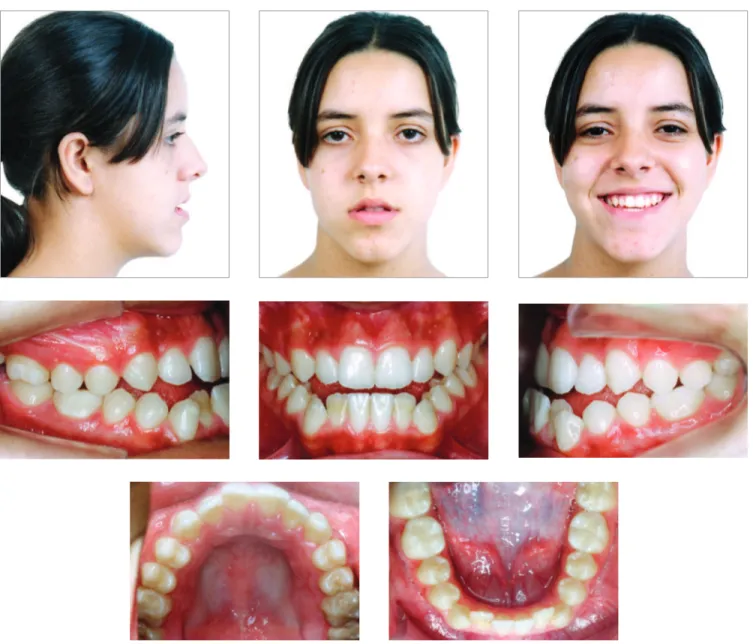 Figure 1 - Initial extra- and intraoral photographs.