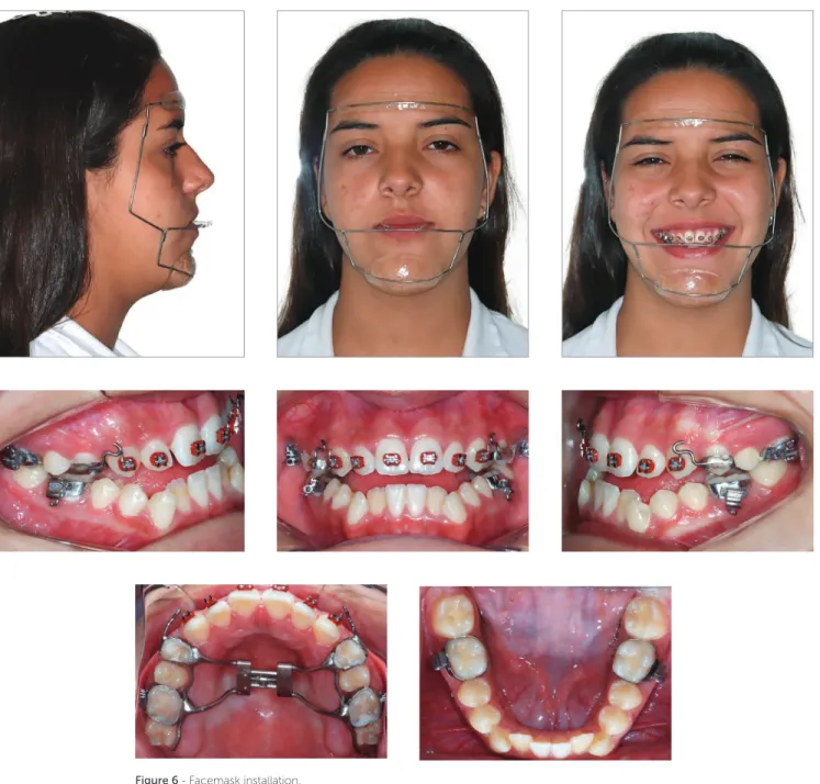 Figure 6 - Facemask installation.
