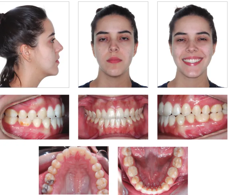 Figure 14 - Seven-years posttreatment extra- and intraoral photographs.