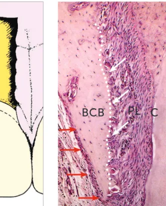 Figure 1 - Buccal bone formed by very thin  buccal cortical bone (BCB) and bundle bone  (white arrows) not always detected in  imag-ing studies