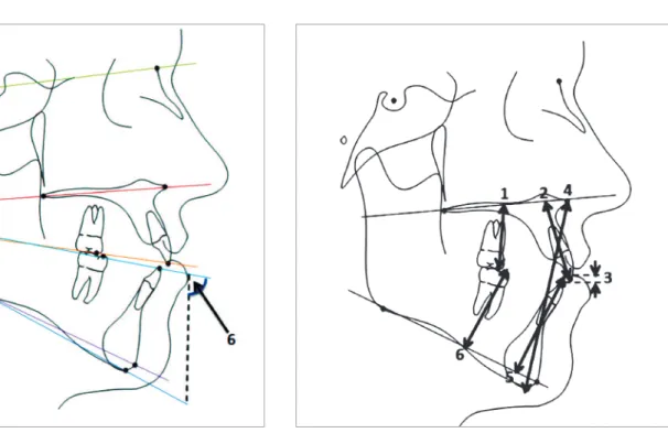 Figure 3 - Cephalometric linear measurements: 1) U6-PP; 2) U1-PP; 3) OB; 