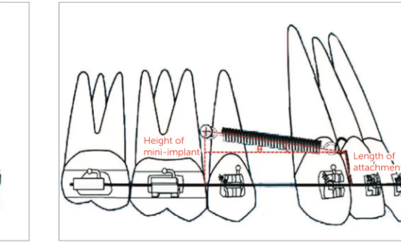 Figure 1  - Force applied from the mini-implant placed between the maxillary  second premolar and first molar to an attachment soldered onto the  arch-wire distal to the lateral incisor.