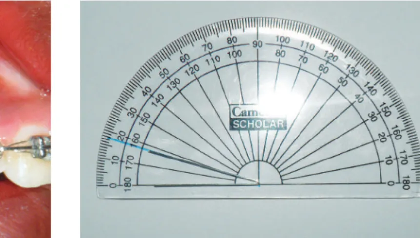 Figure 5  - Direct measurement of the angle made by the applied force to the occlusal plane.