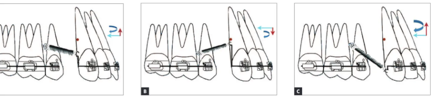 Figure 10 - A) Outcome IIIA: The point of force application lies occlusal to the mini-implant and the CRes of the maxillary anterior teeth