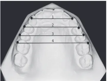 Figure 3  - 1) Inter-canine width (3-3), which is the distance between the right  and left maxillary canine cusp tips