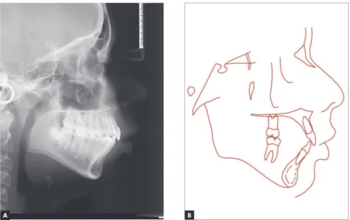 Figure 12 - Final profile cephalometric radiograph (A) and cephalometric tracing (B). 