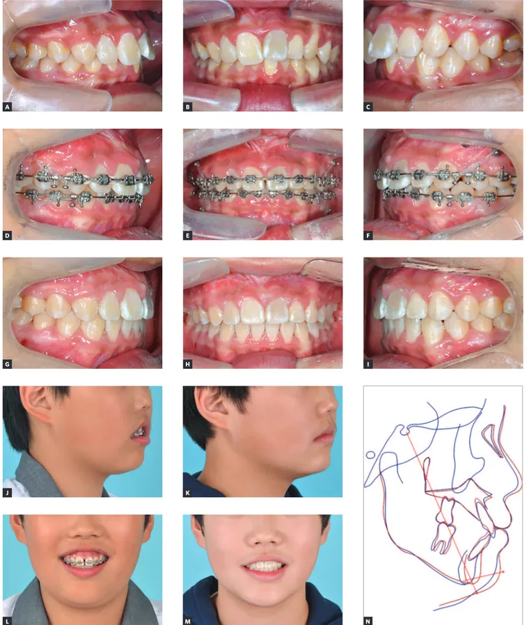 Figure 1 - A growing patient (12-year-old boy) showing severe vertical incompetency. A-I) A total arch intrusion was constantly conducted for about 16 months BEHKMNCFIADGJL