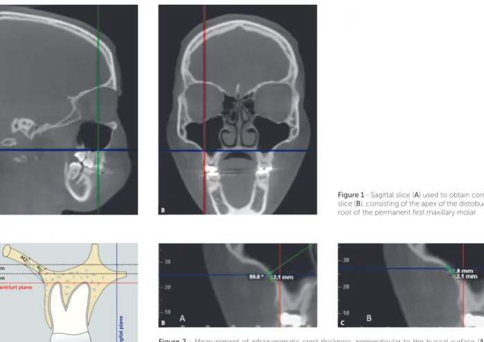 Figure 1 - Sagittal slice (A) used to obtain coronal  slice (B), consisting of the apex of the distobuccal  root of the permanent first maxillary molar.