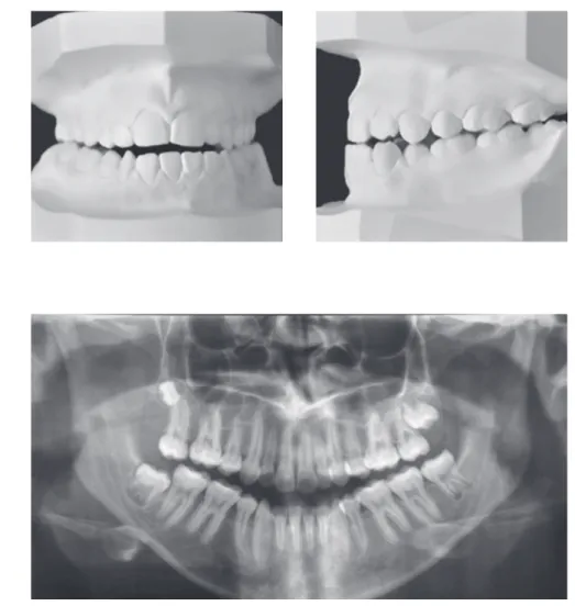 Figure 2 - Pretreatment dental casts.