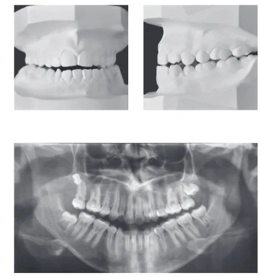 Figure 2 - Pretreatment dental casts.