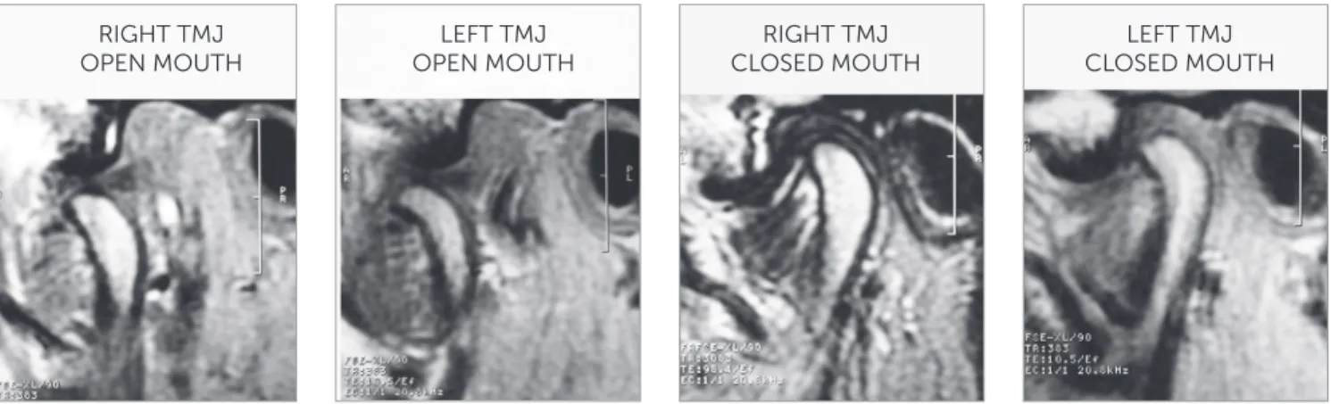 Figure 7 - Final magnetic resonance of right and left TMJs, with opened and closed mouth