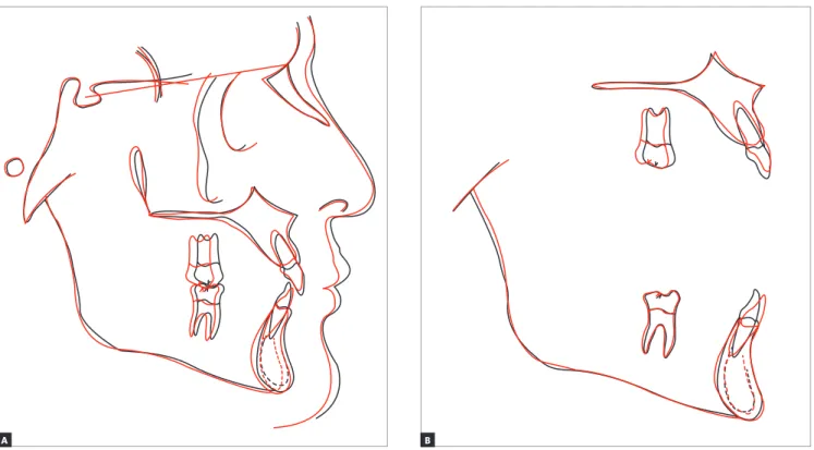 Figure 13 - Total superimposition (A), maxillary and mandibular superimpositions (B) of initial (black) and final (red) cephalometric tracing.