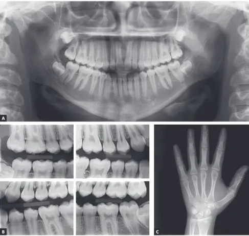 Figure 3 - Baseline panoramic (A), interproxi- interproxi-mal (B) and hand and wrist (C) radiographs.