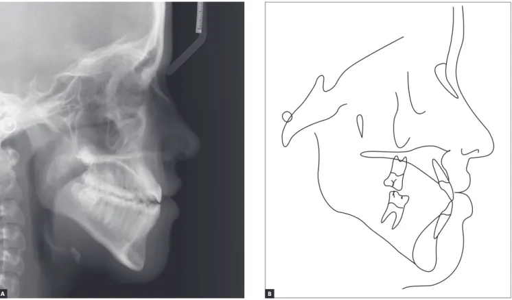 Figure 4 - Baseline cephalometric profile radiograph (A) and cephalometric tracing (B)