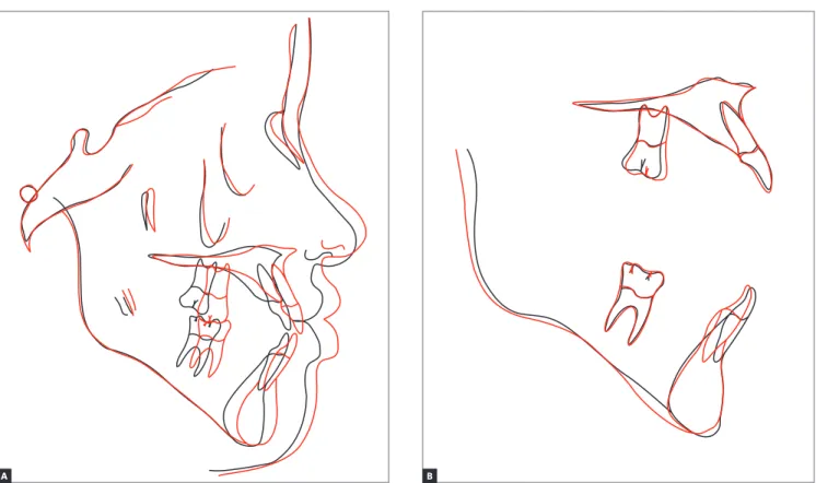 Figure 9 - Total (A) and partial (B) superimpositions of baseline (black) and final (red) cephalometric tracings