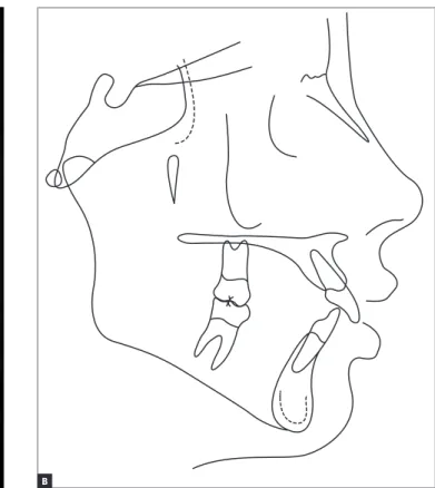 Figure 4 - Initial lateral cephalogram (A) and cephalometric tracing (B). 