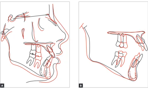 Figure 10 - Total (A) and partial (B) cephalometric  superimpositions of initial (black) and final (red)  tracings