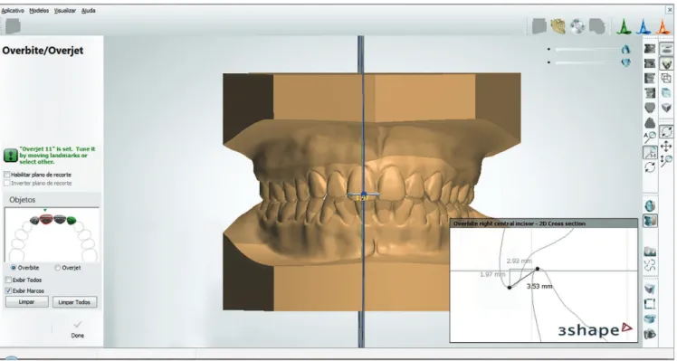 Figure 4 - Overbite measurement in the digital model using the Ortho Analyzer software.